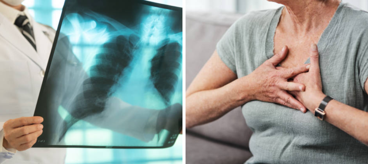 Autoridades de salud del Valle del Cauca piden estar alerta a los síntomas de la tuberculosis: en la región se han registrado más de 700 casos