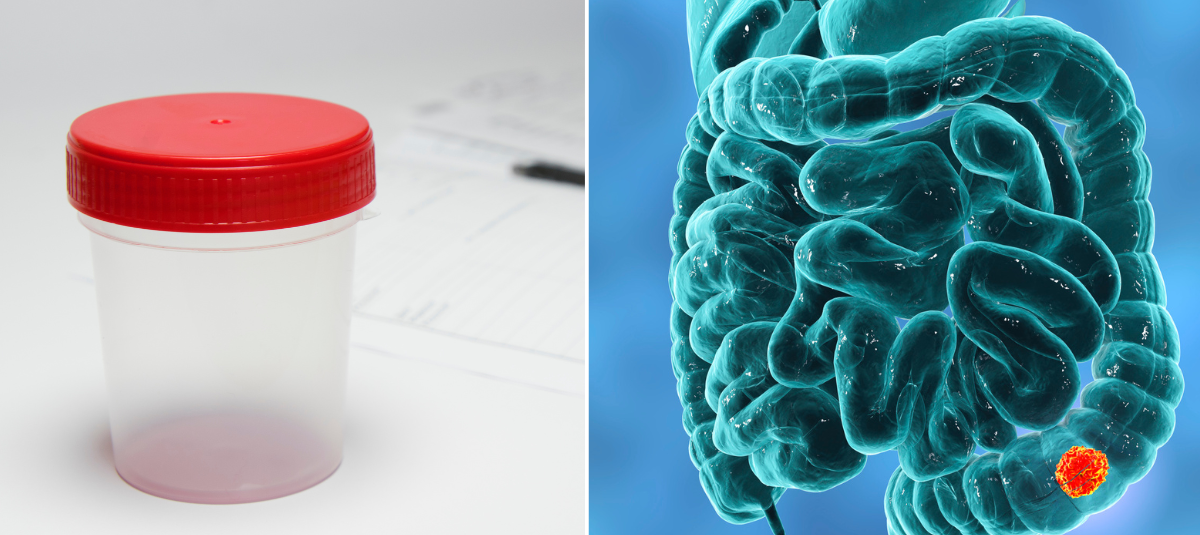 El sencillo test que podría alertarlo a tiempo sobre el cáncer de colon ...