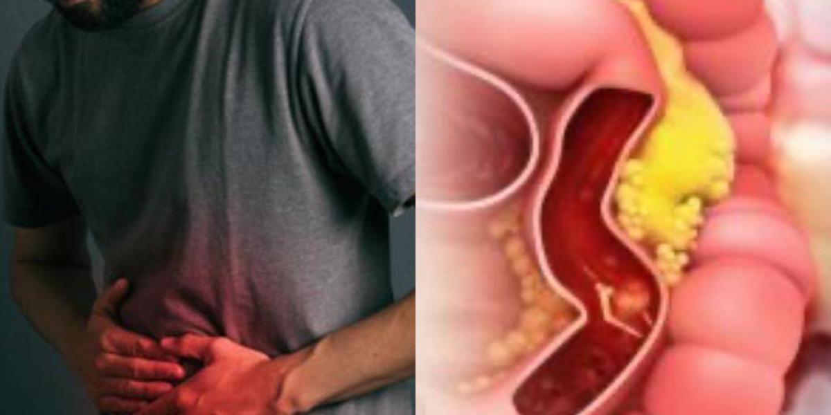Cáncer de colon está en aumento en adultos jóvenes en Colombia, ¿cómo prevenirlo?
