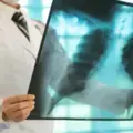 tuberculosis