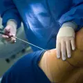 Procedimiento estético de liposucción
