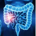 Cáncer de colon en mujeres.