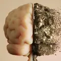 Alzheimer