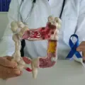 El dolor abdominal puede ser un síntoma del cáncer colorrectal.