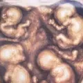 Nacieron en Medellín los cuatrillizos idénticos de una pareja de Caucasia: estos son los nombres de los bebés