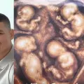 Nacieron en Medellín los cuatrillizos idénticos de una pareja de Caucasia: estos son los nombres de los bebés