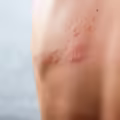 Uno de los signos de contagio son las pústulas en diferentes zonas del cuerpo.