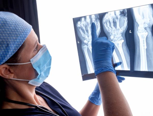Mano fracturada, fractura, radiografía, mano