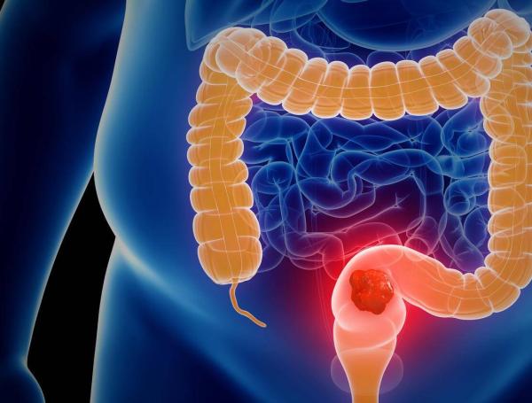 Cáncer de colon está en aumento en adultos jóvenes en Colombia, ¿cómo prevenirlo?