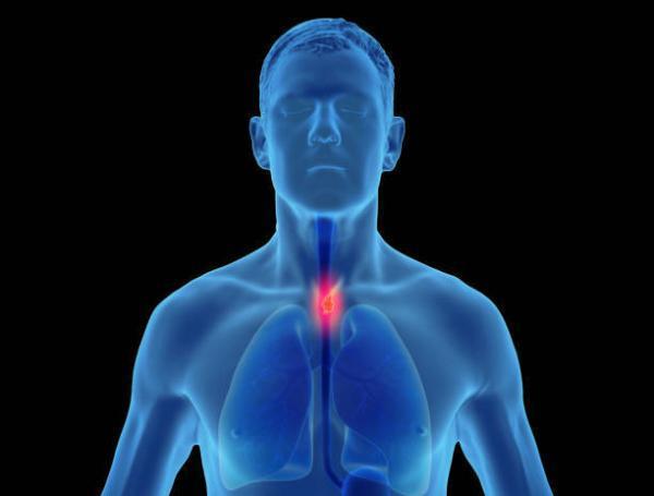 cáncer de esófago