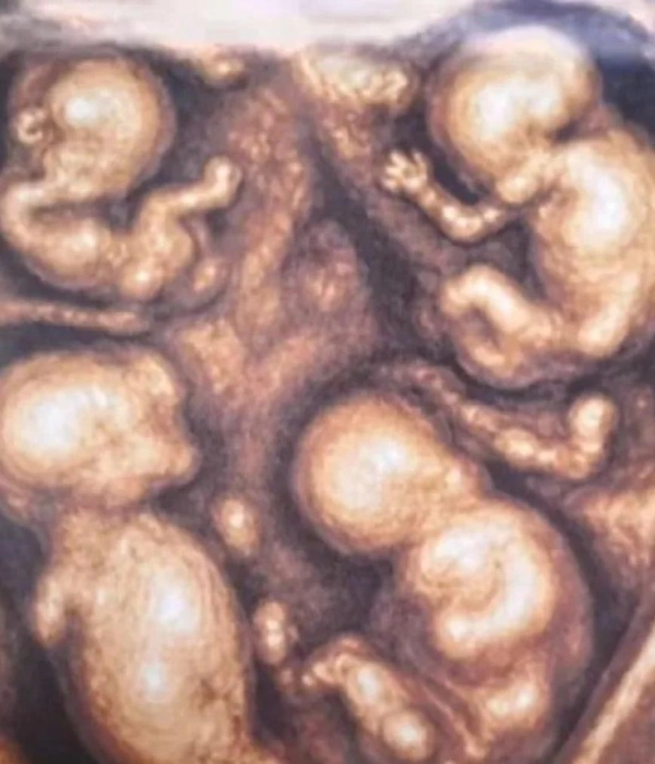 Nacieron en Medellín los cuatrillizos idénticos de una pareja de Caucasia: estos son los nombres de los bebés