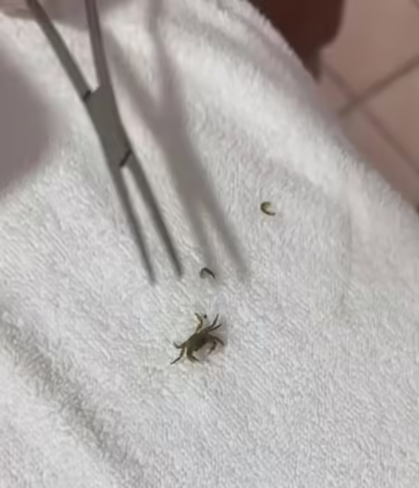 Le extraen cangrejo del oído a niño tras pasar un día en la playa (+video) 2 El video muestra la extracción del cangrejo por un médico