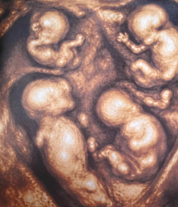 Ecografía 3D de los cuatrillizos en las primeras semanas de gestación.