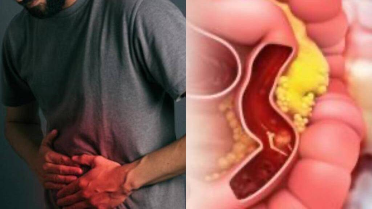 Santander ocupa el tercer puesto a nivel nacional con más casos de pacientes con cáncer colorrectal: estas son las formas de prevenir esta enfermedad