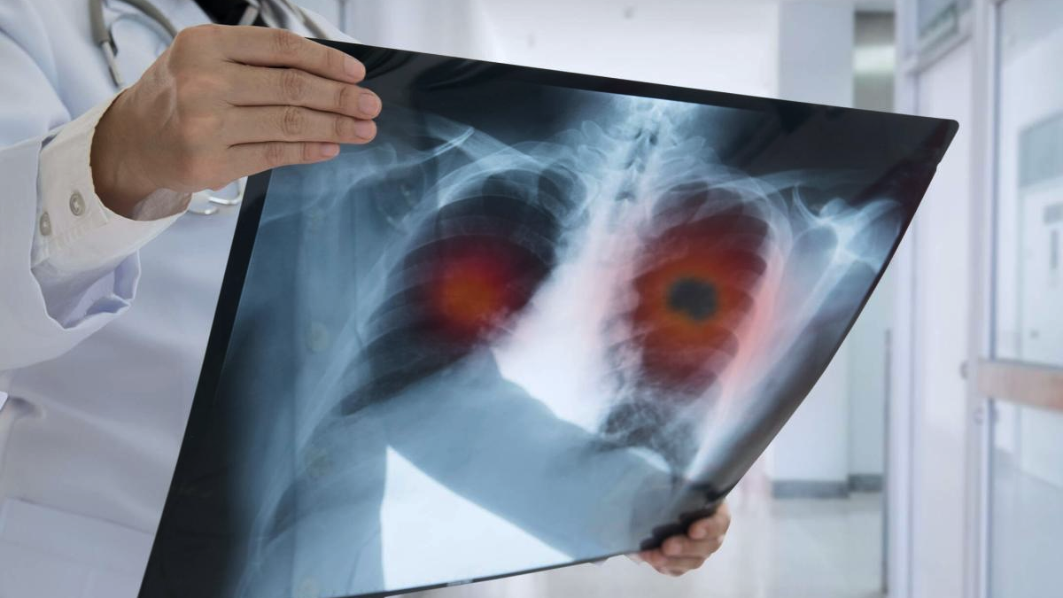 Un estudio descubre que caminar rápido puede reducir el riesgo de cáncer de pulmón en un 50 %