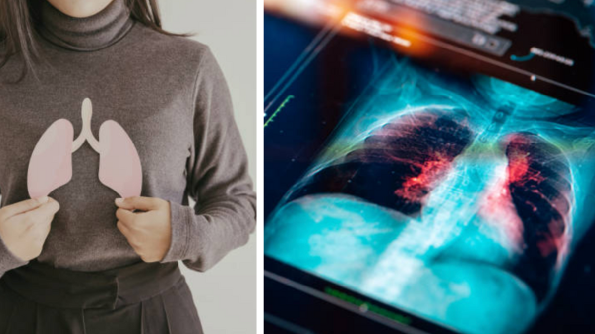¿Cuándo una tos deja de ser común? Cinco síntomas persistentes que pueden alertar sobre cáncer de pulmón y requieren evaluación médica