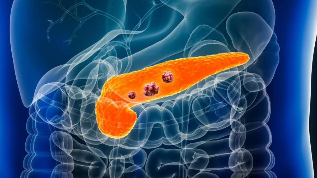 Desarrollan un test de sangre que promete detectar el cáncer de páncreas en minutos