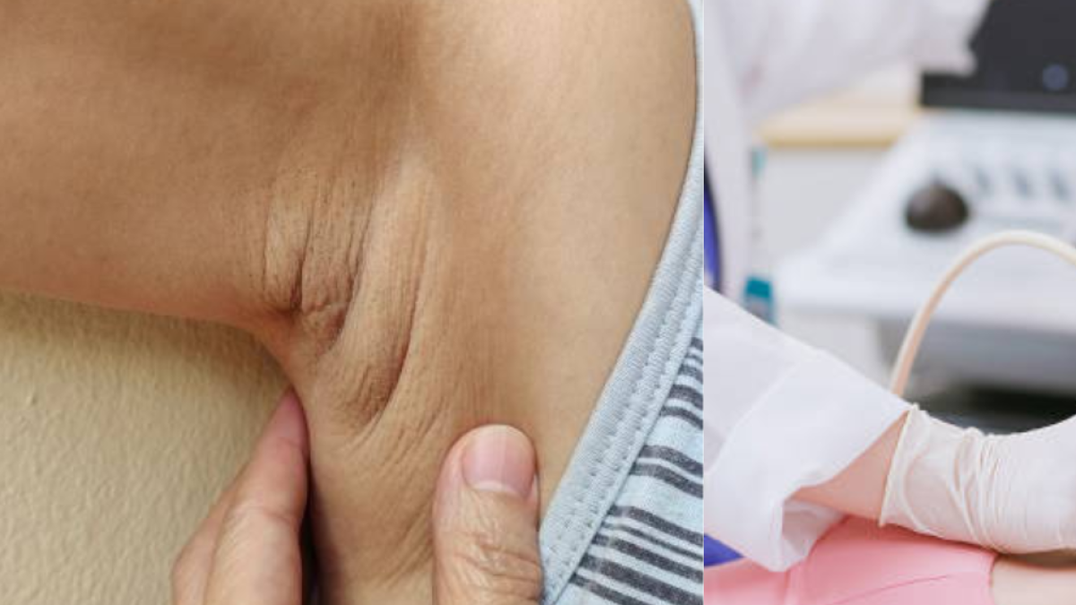 foliculitis axila bulto