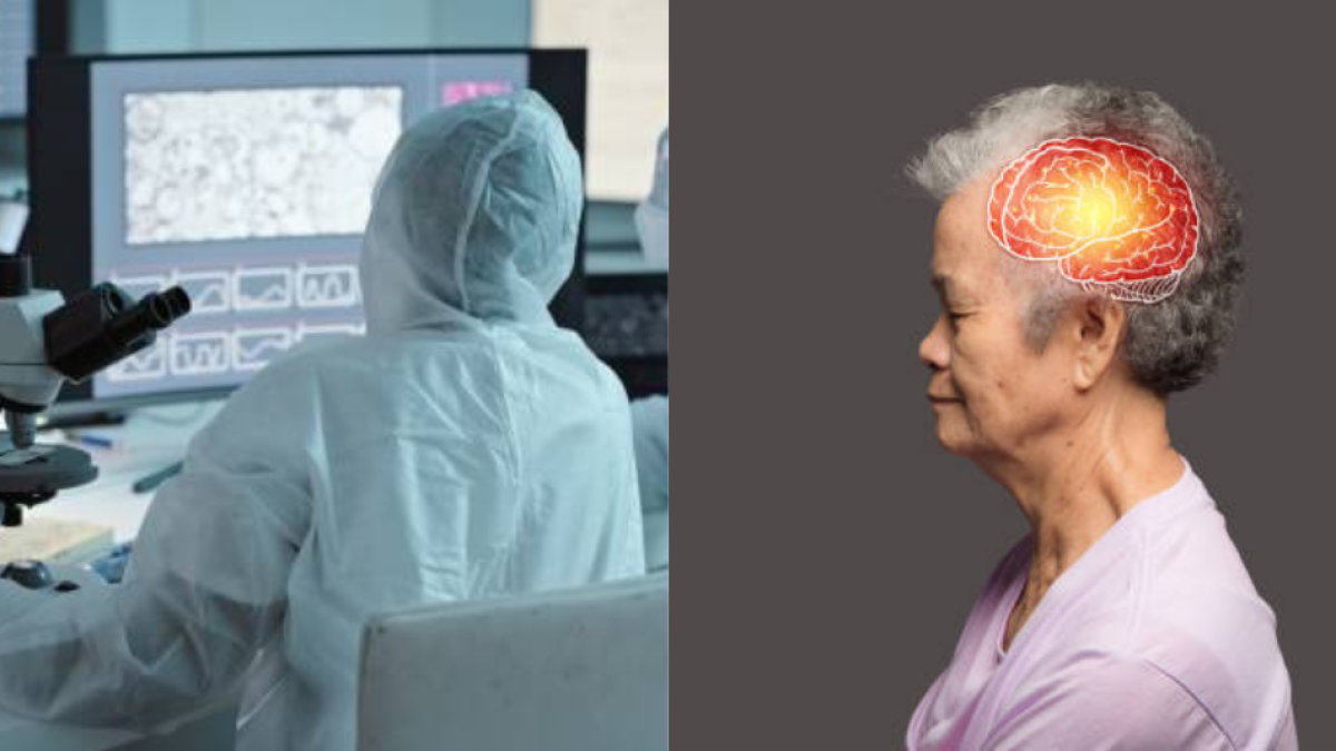 Alzheimer avanza más rápido en mujeres que en hombres: estudio revela causas científicas