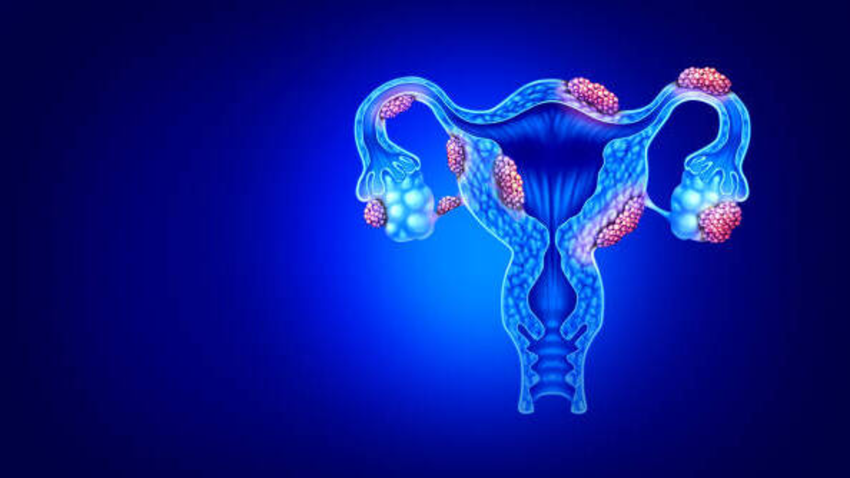 ¿Qué es la endometriosis, enfermedad que padece joven de 25 años que pide eutanasia en Colombia?