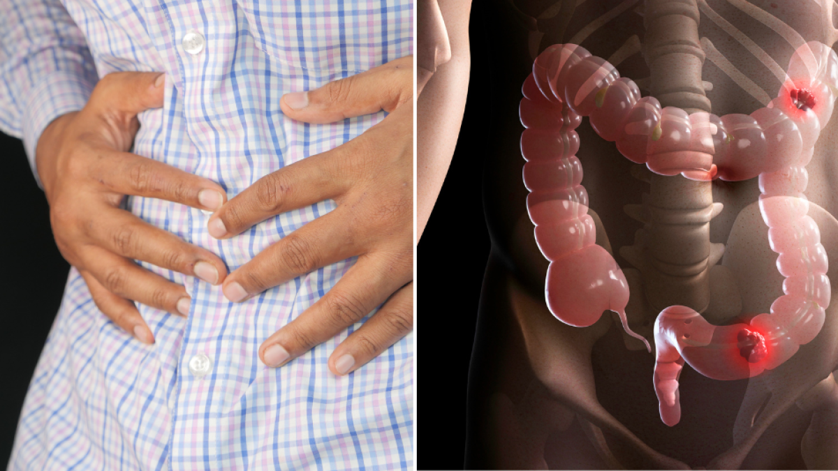 Cáncer de colon: cuáles son sus síntomas, factores de riesgo y cómo prevenirlo