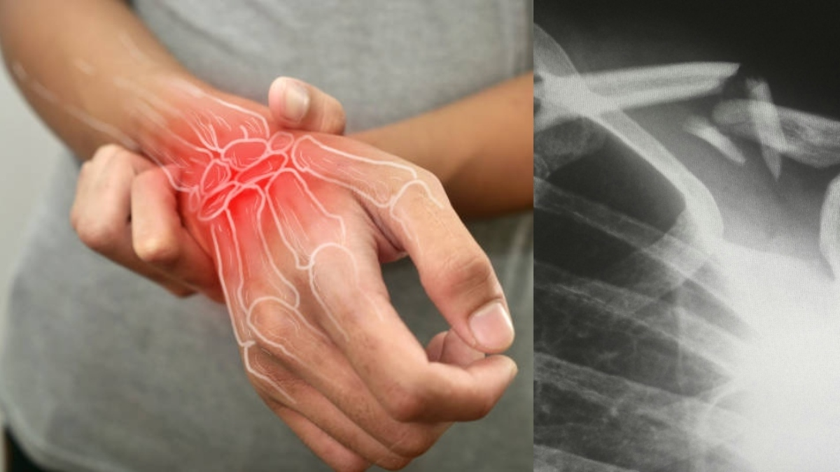 Día Mundial de la Osteoporosis: una enfermedad silenciosa que afecta la calidad de vida