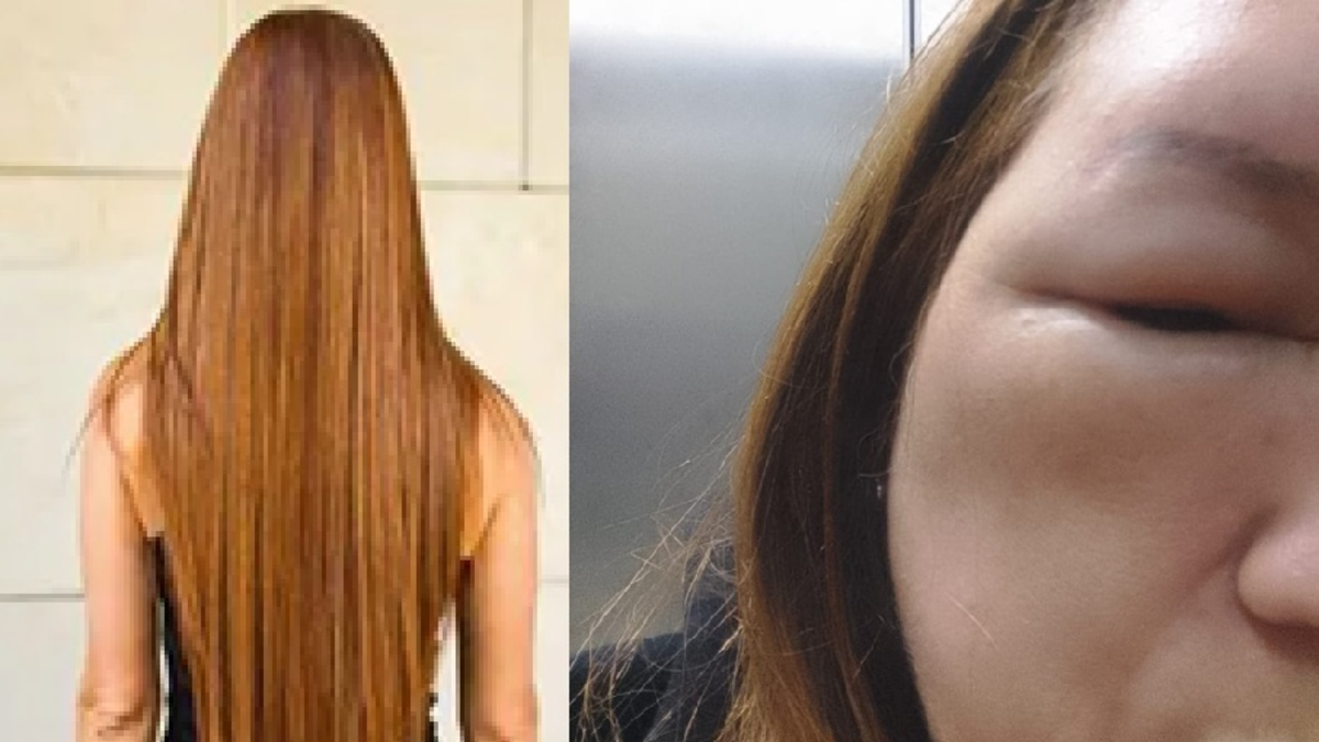 Mujer se hizo una keratina en reconocido centro de belleza de Medellín y denuncia que tuvo grave reacción alérgica: se le inflamó el cráneo y su cara