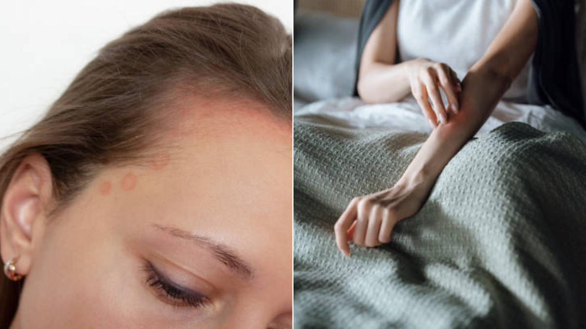 Psoriasis: la enfermedad que equivocadamente muchos tildan de 'nerviosa' y que afecta más que la piel