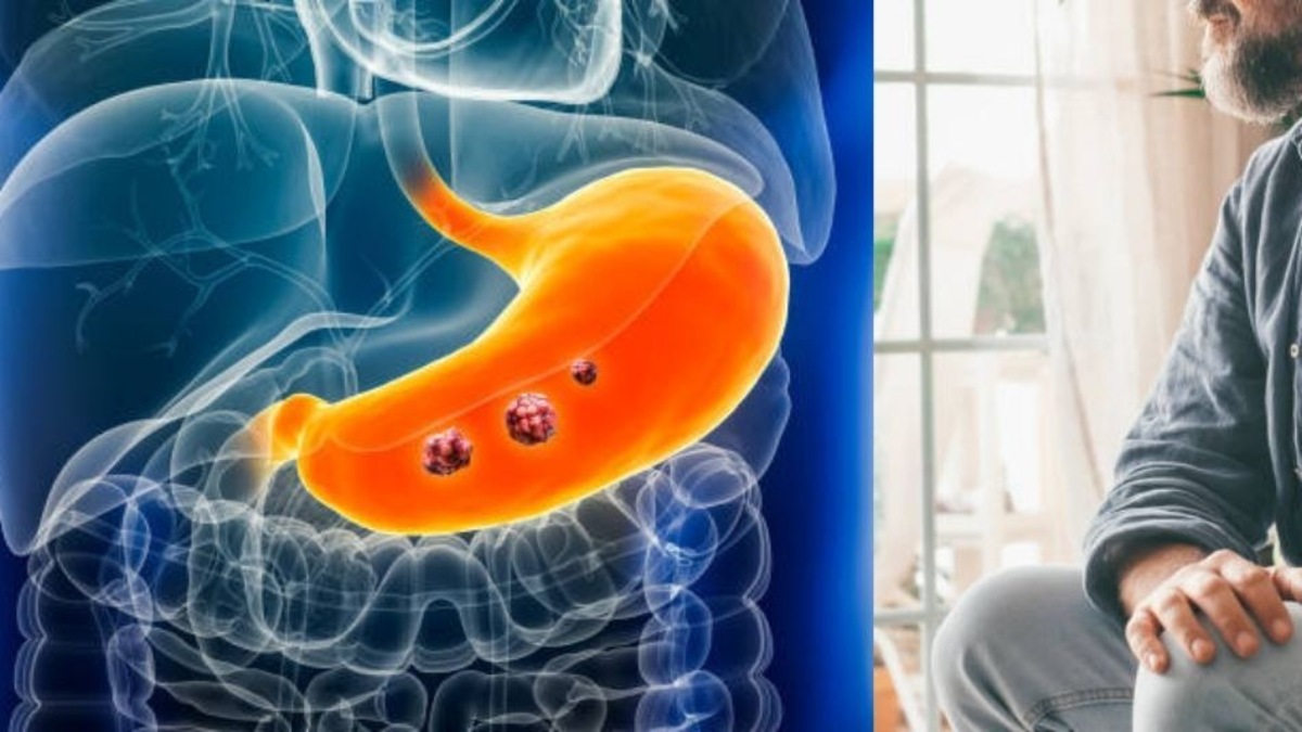 ¿Cuáles son los primeros síntomas del cáncer de estómago, según la Clínica Mayo?