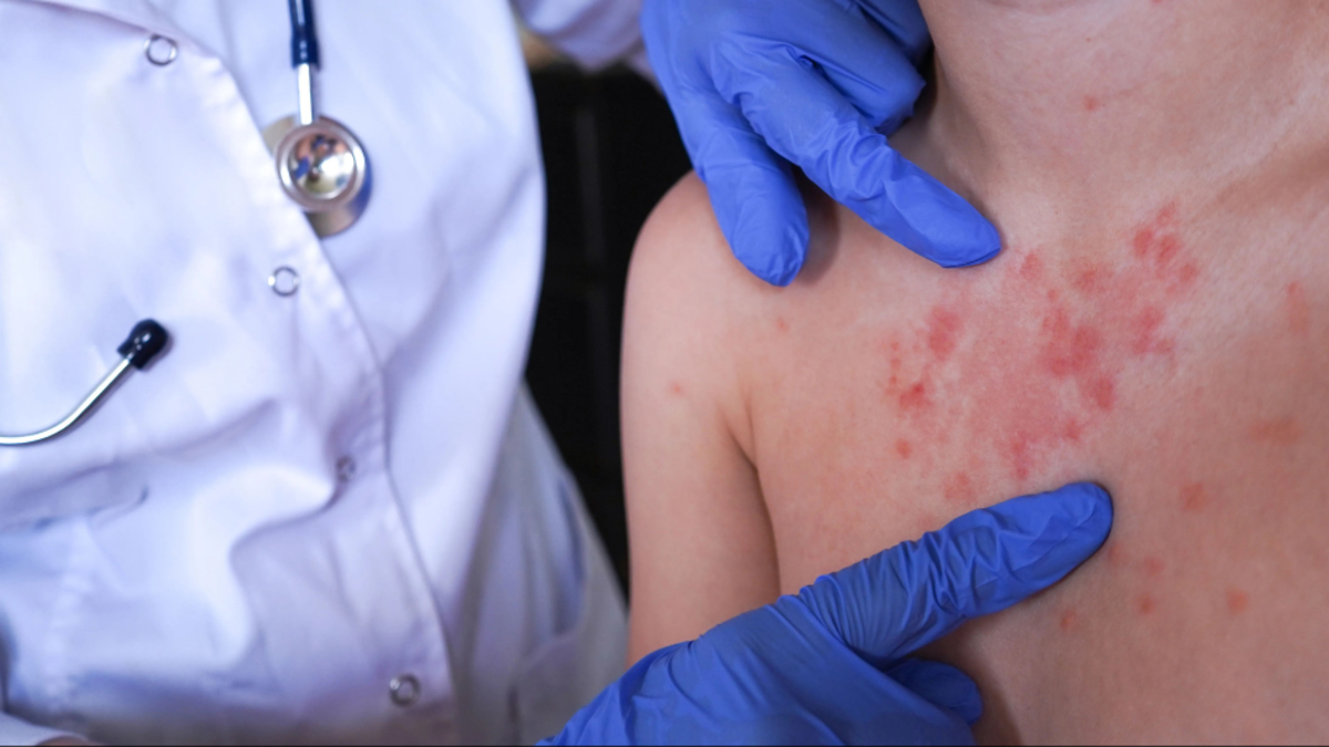 Bogotá concentra tres de los cuatro casos importados de sarampión confirmados en Colombia