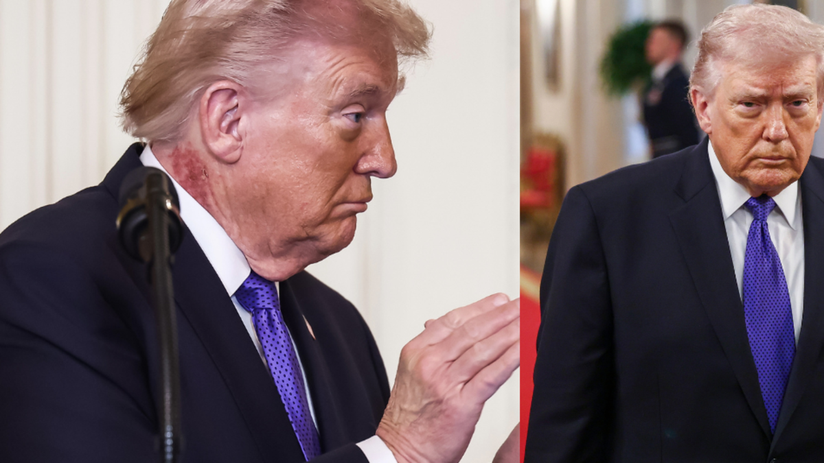 Mancha roja en el cuello del presidente Donald Trump reaviva rumores sobre su estado de salud; médico oficial de la Casa Blanca se pronunció