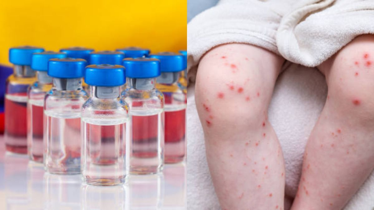 ¿Cómo saber si ya tiene la dosis indicada de la vacuna contra el sarampión en Colombia? Estas son las recomendaciones del Ministerio de Salud