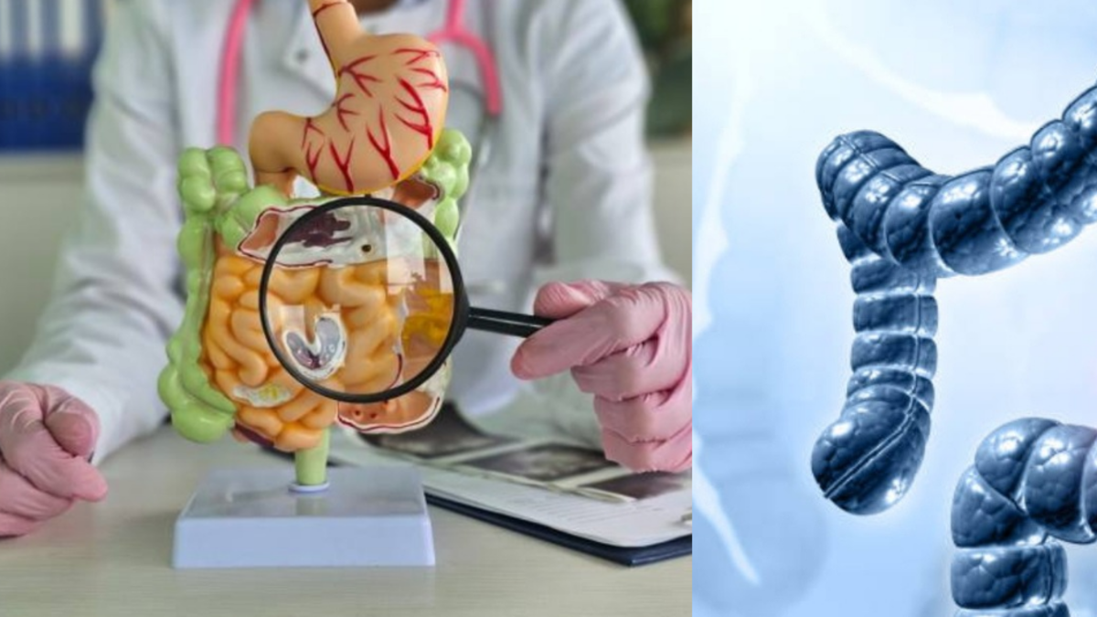 Cáncer de colon aumenta en adultos jóvenes menores de 50: los médicos ya saben por qué está pasando esto