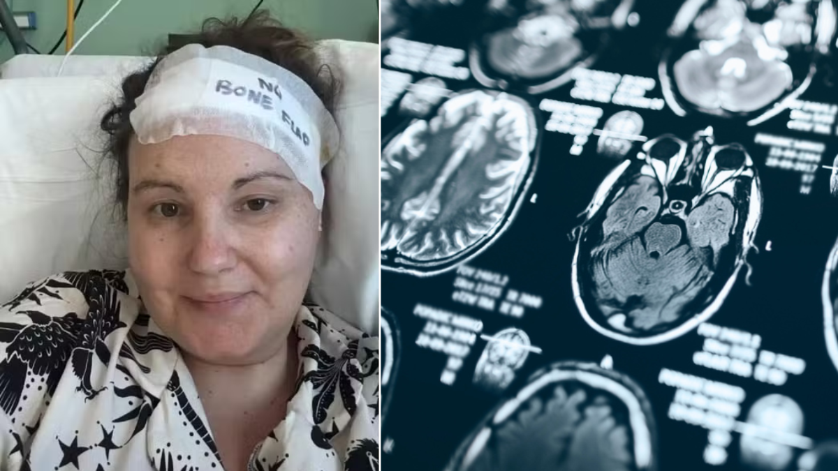 Mujer galesa ignoró fuertes dolores de cabeza durante 20 años y descubrió un tumor cerebral del tamaño de una 'mandarina': 'Sentí rabia y alivio'
