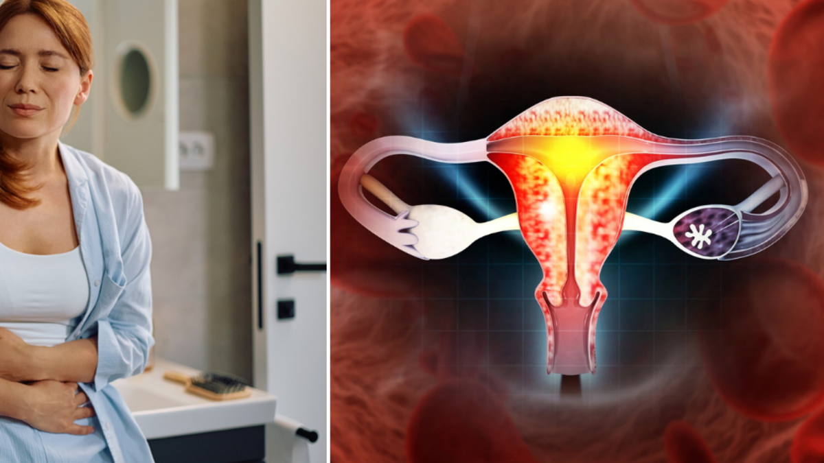 Ovario poliquístico: los dos síntomas clave que podrían indicarle el síndrome antes de que se dé cuenta