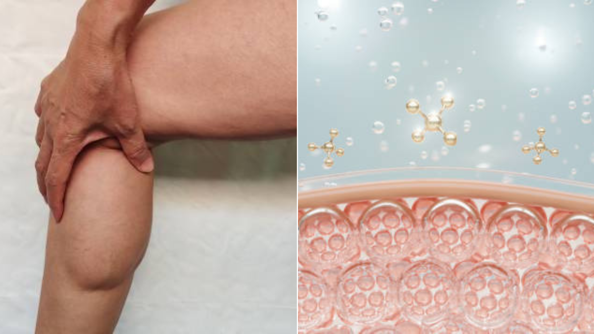 Lipedema: la enfermedad frecuente que se confunde con celulitis y obesidad