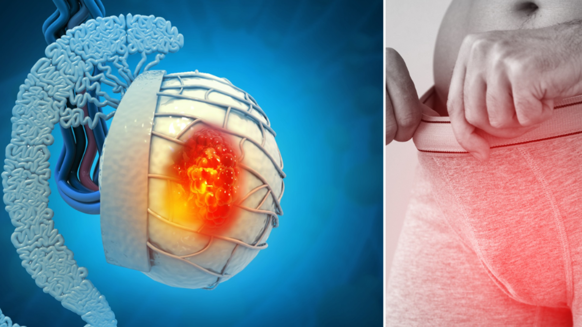 Cáncer testicular: los cuatro síntomas del ‘bulto silencioso’ que más afectan a hombres jóvenes