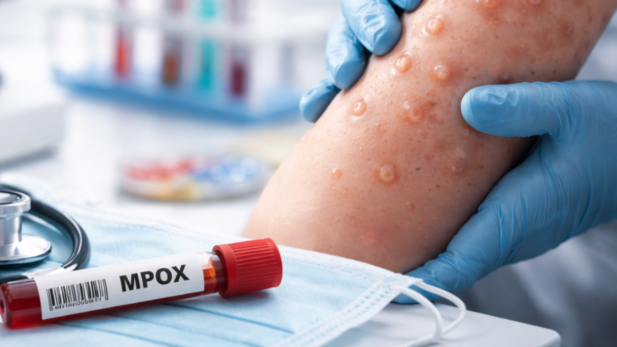 Qué es la viruela símica (mpox clado ld), síntomas y cómo se contagia: MinSalud confirmó primer caso de nueva variante en Colombia