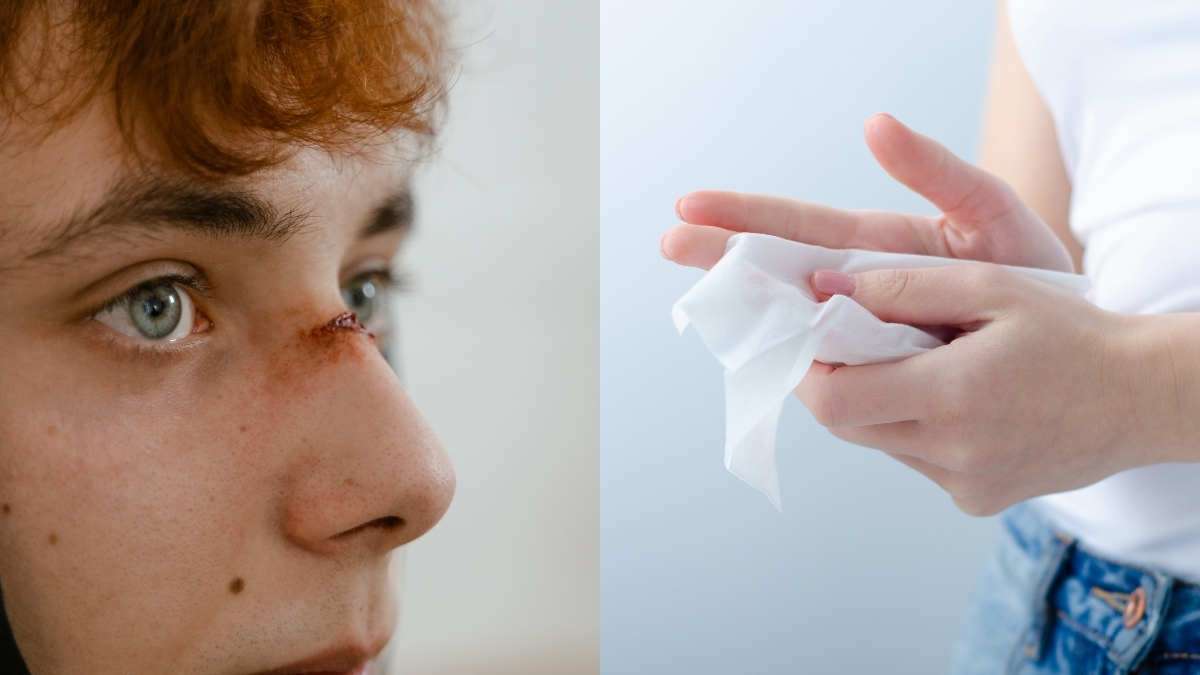 Invima alerta sobre el uso de toallas húmedas en la piel: advierten de riesgos por graves infecciones en tratamientos inadecuados con heridas