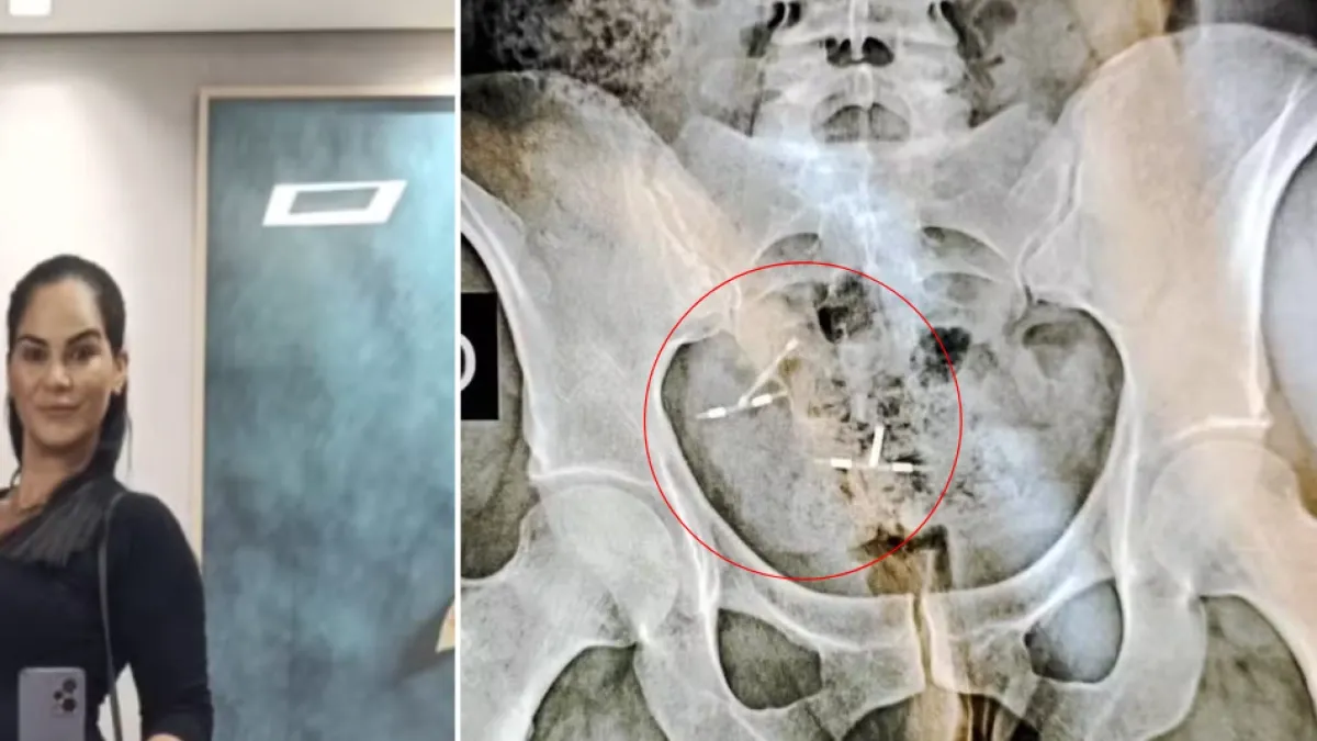 Mujer pierde parte del intestino y el útero tras descubrir que tenía dos DIU por error médico: 'Me colocaron otra T pensando que se había expulsado’