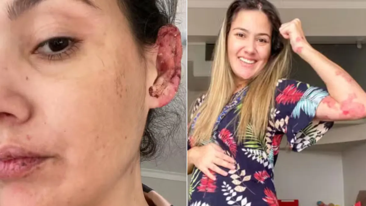 Mujer sufre dolorosa enfermedad autoinmune que deja su cuerpo ‘en carne viva’; comenzó con unas ampollas: ‘Tenía que arrancarme trozos de la mejilla’