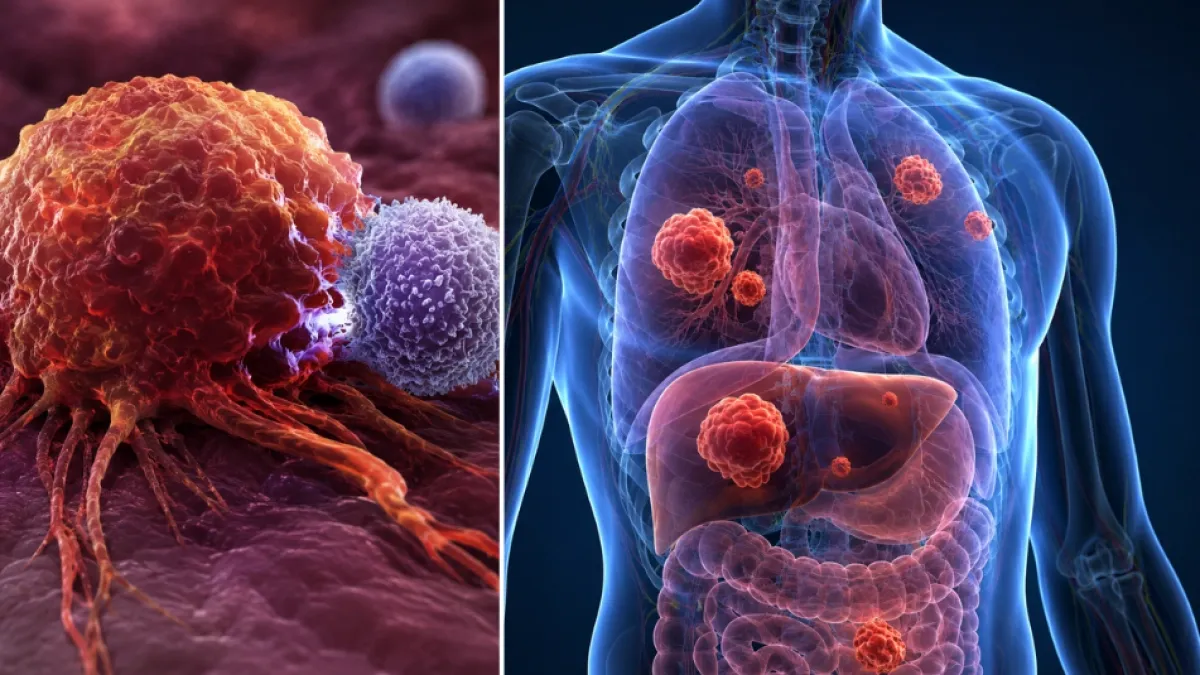 Los tipos de cáncer que los médicos descubren por accidente cuando buscan otra cosa: el dolor de espalda puede revelar algo más grave