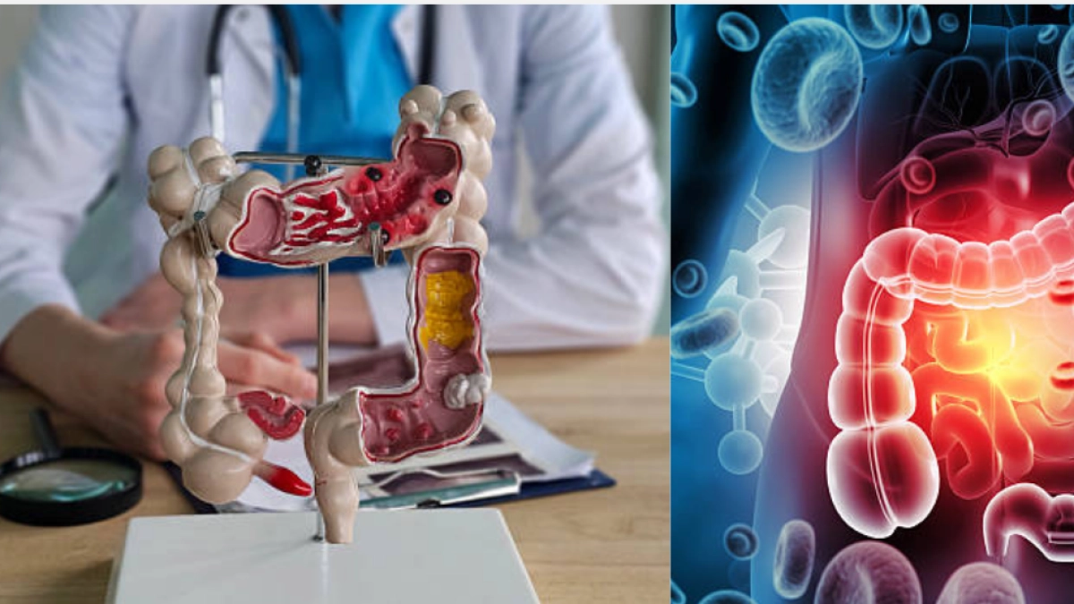 Cinco señales silenciosas del cáncer de colon que no se deben ignorar, según experto médico
