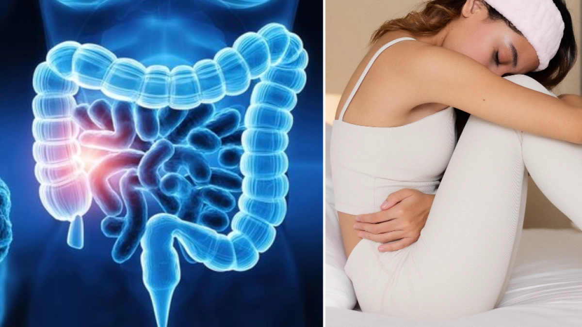 Cáncer de colon en mujeres: siete síntomas que pueden confundirse con la menstruación, según estudios