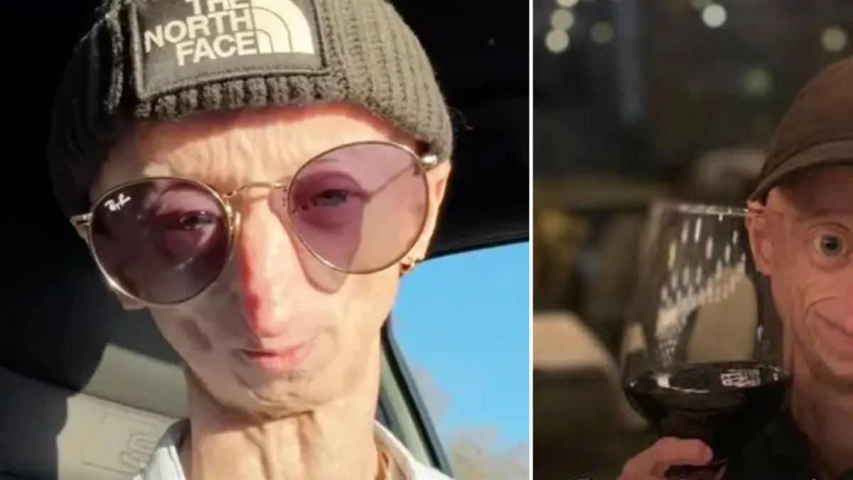 Muere Michiel Vandeweert a los 28 años: el 'influencer' que mostró su vida con una rara enfermedad que acelera el envejecimiento