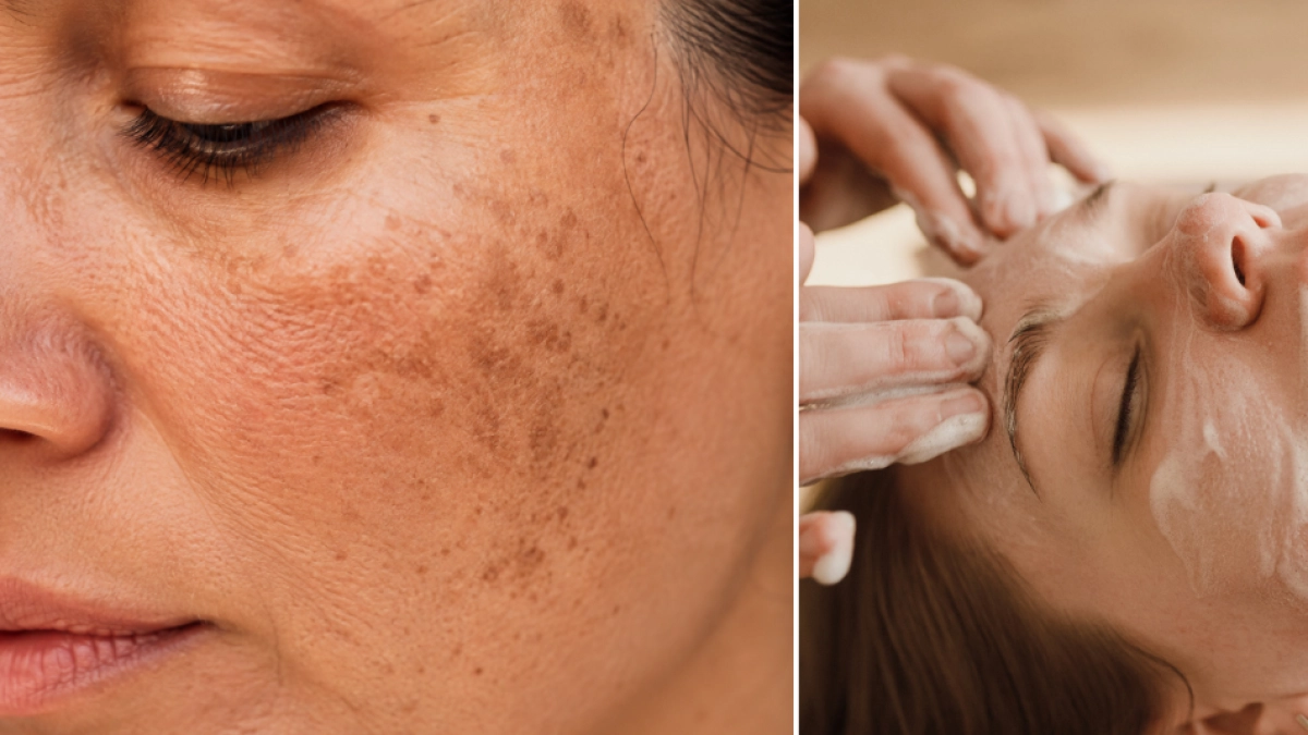 ¿Otra mancha y no sabe qué significa? La regla ABCDE que recomiendan los dermatólogos para identificar posibles señales de melanoma