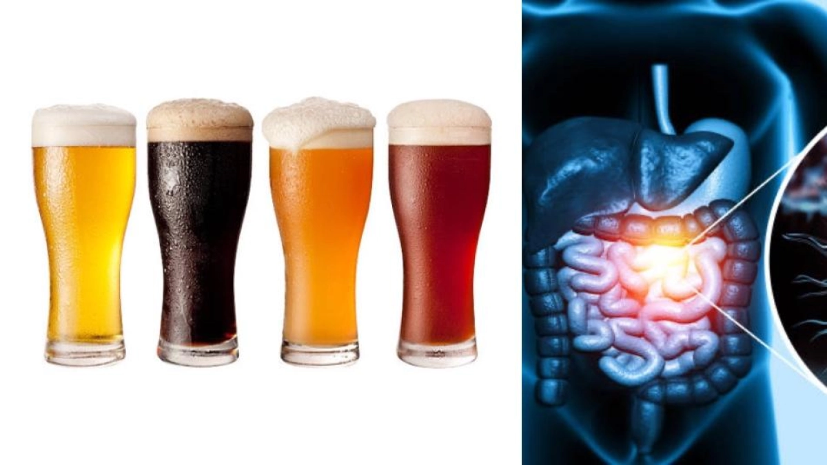 El color de la cerveza podría ayudar a detectar señales de cáncer de colon: así funciona la campaña