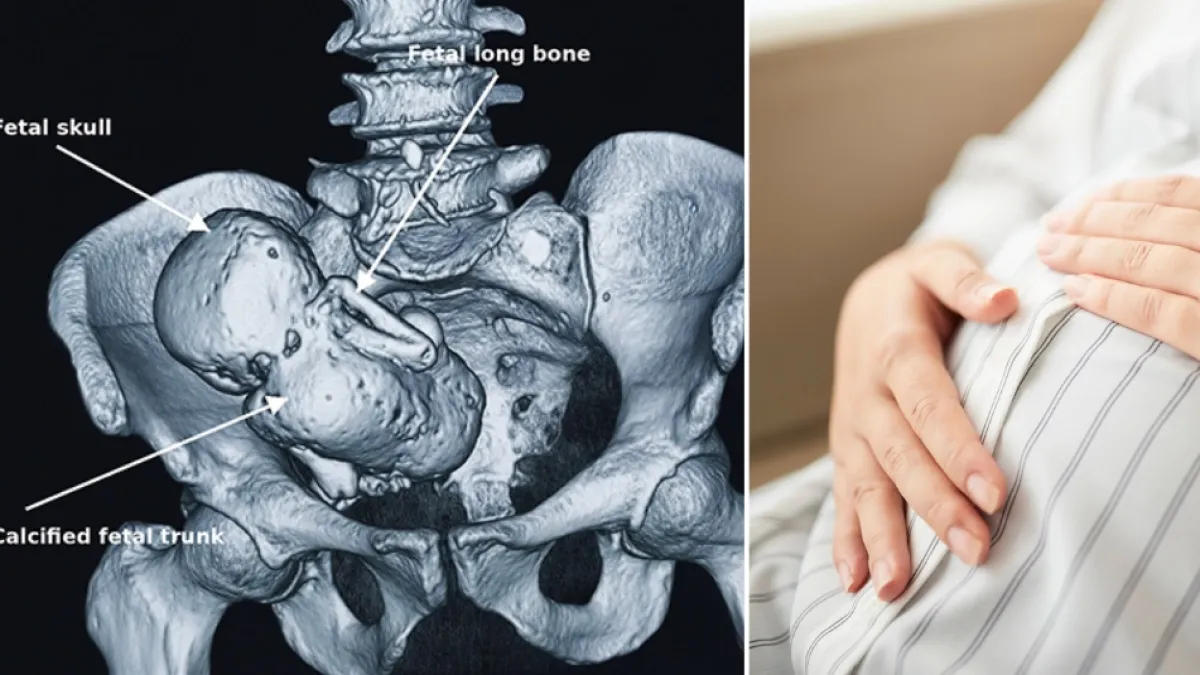 Mujer de 42 años sufrió fuertes dolores abdominales durante tres años: médicos descubrieron un 'bebé de piedra' calcificado de 18 centímetros