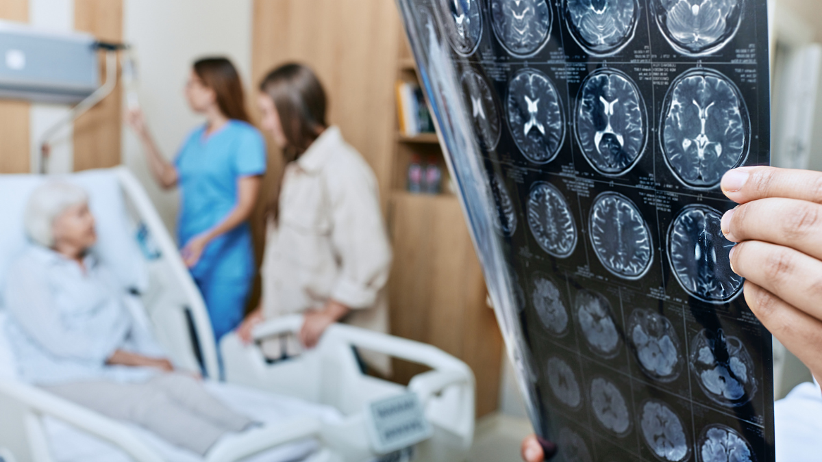 Señales para identificar derrame cerebral como el que tuvo Paola Calle