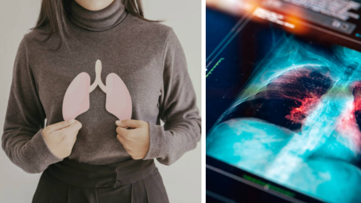 ¿Cuándo una tos deja de ser común? Cinco síntomas persistentes que pueden alertar sobre cáncer de pulmón y requieren evaluación médica